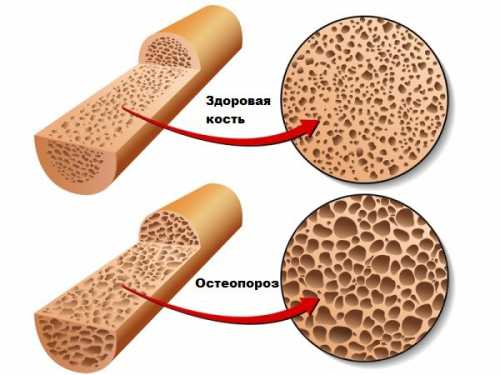 паратрофия у детей: развитие, причины, лечение